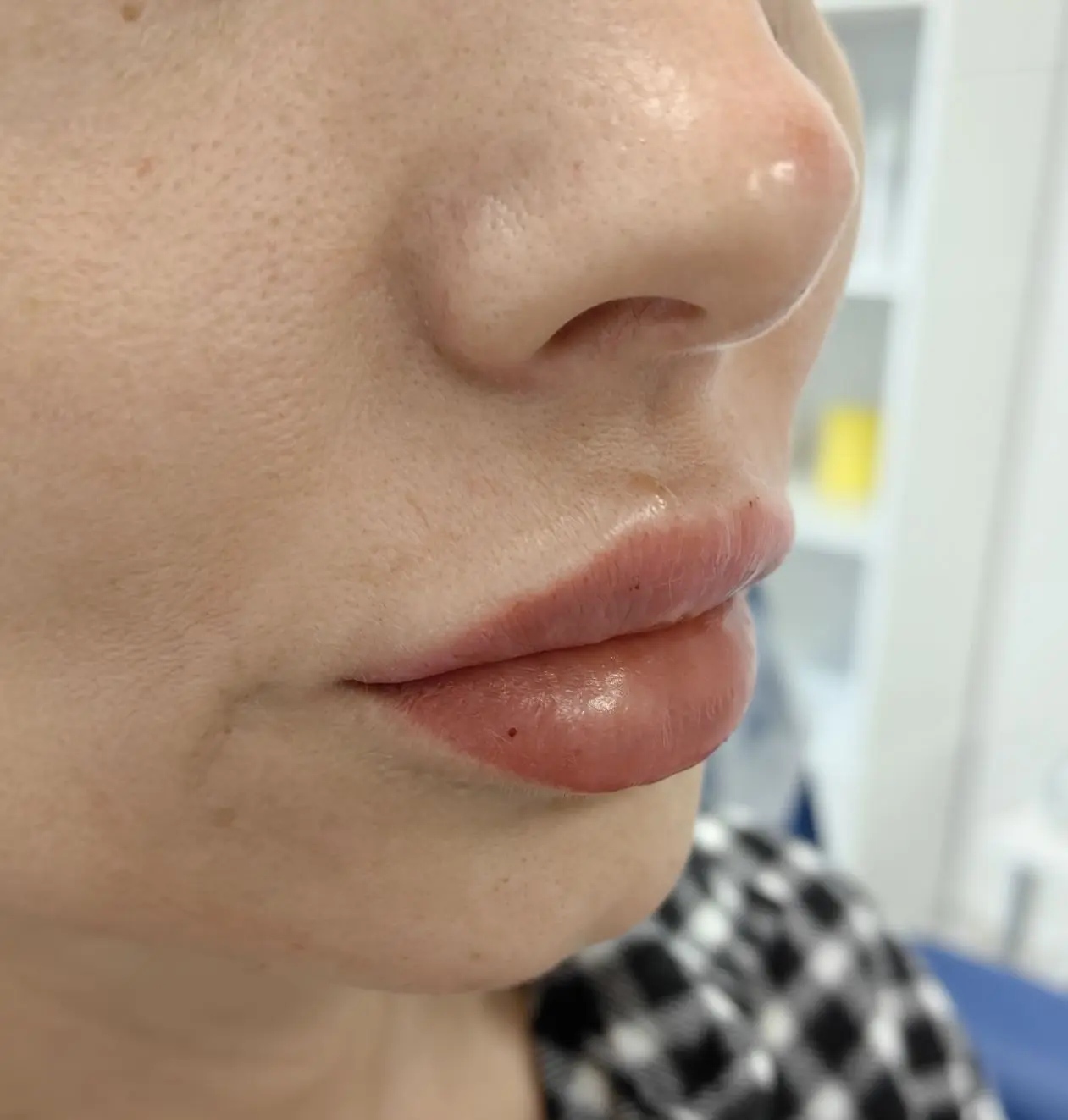 Скидка на контурную пластику губ: препарат Viscoline deep (Россия) 10.000 р. вместо 12.000